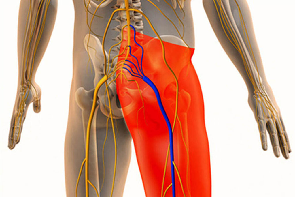 Remedies for Managing Sciatica Symptoms