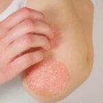 Understanding the Latest Approaches in Eczema Treatment