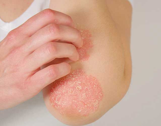 Understanding the Latest Approaches in Eczema Treatment