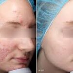 Understanding the Triggers of Rosacea