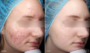 Understanding the Triggers of Rosacea