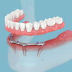 How All-on-4 Dental Implants Are Transforming Smiles Worldwide