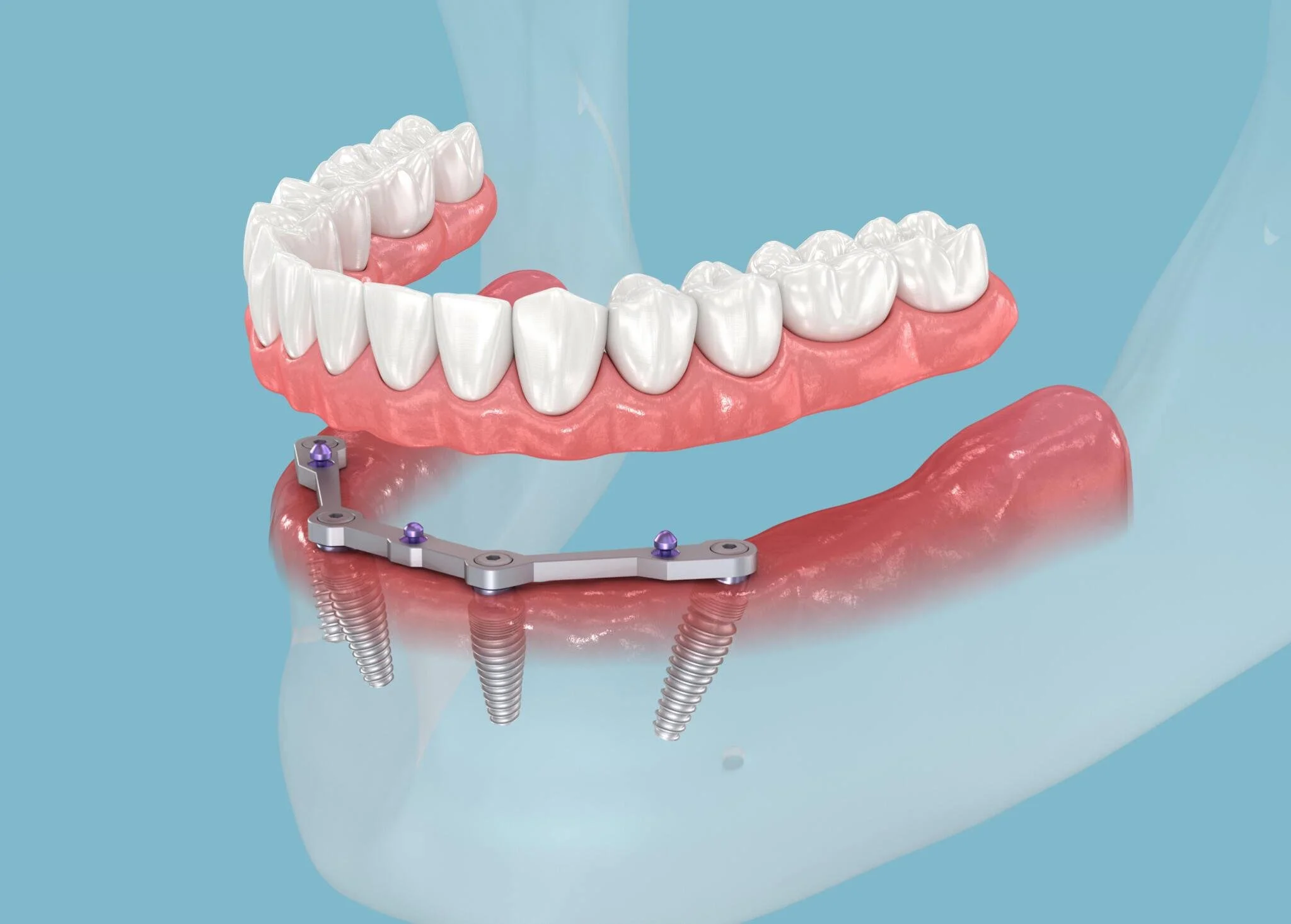 How All-on-4 Dental Implants Are Transforming Smiles Worldwide