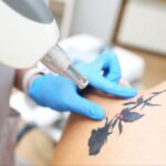 Understanding the Tattoo Removal Process