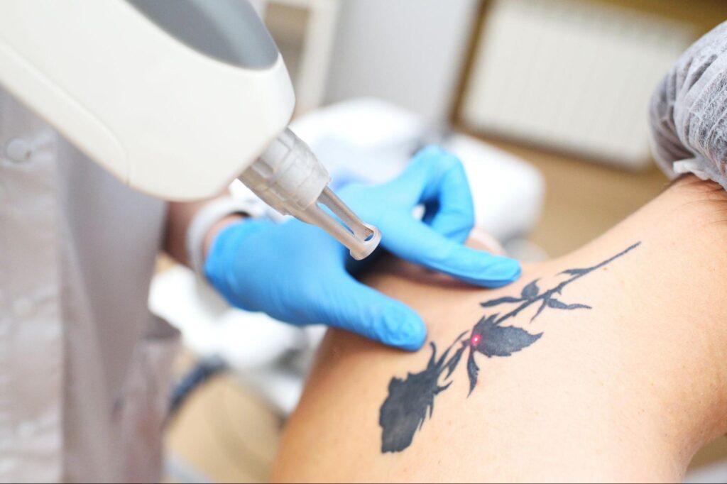 Understanding the Tattoo Removal Process