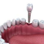 Benefits of Dental Implants for Missing Teeth