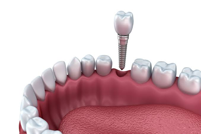 Benefits of Dental Implants for Missing Teeth
