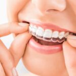 Do You Need to Wear Retainers After Invisalign Treatment?