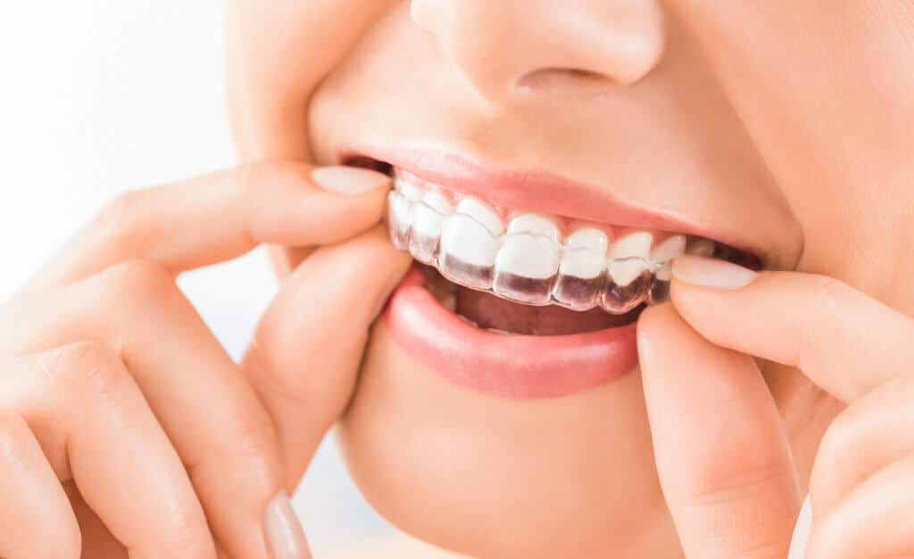 Do You Need to Wear Retainers After Invisalign Treatment?