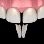 How Beneficial are Veneers for Gaps Between Teeth?