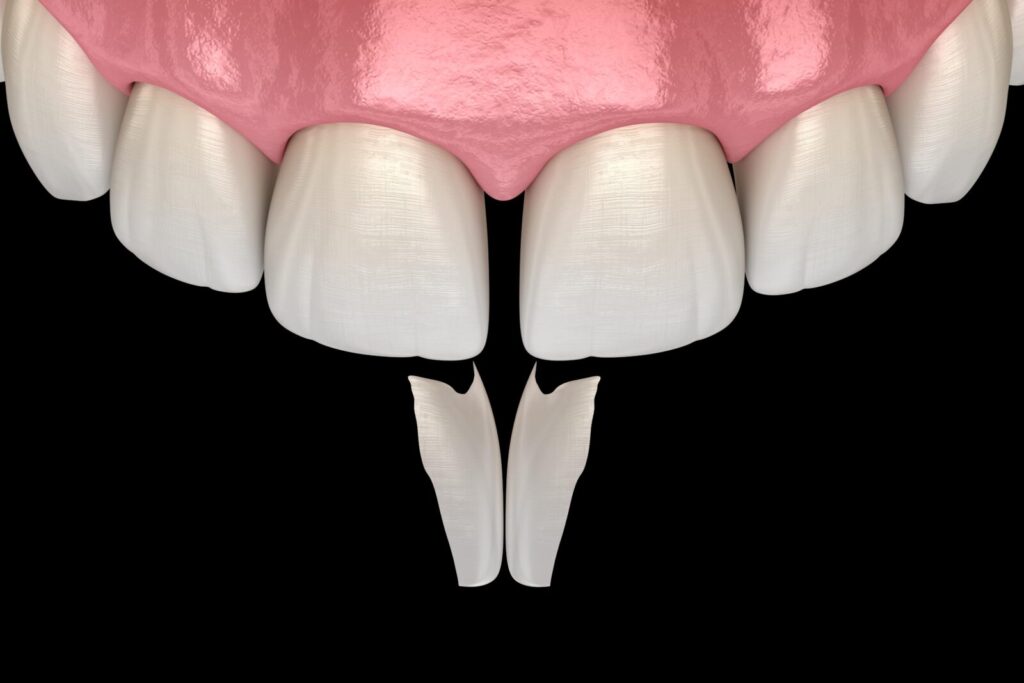 How Beneficial are Veneers for Gaps Between Teeth?