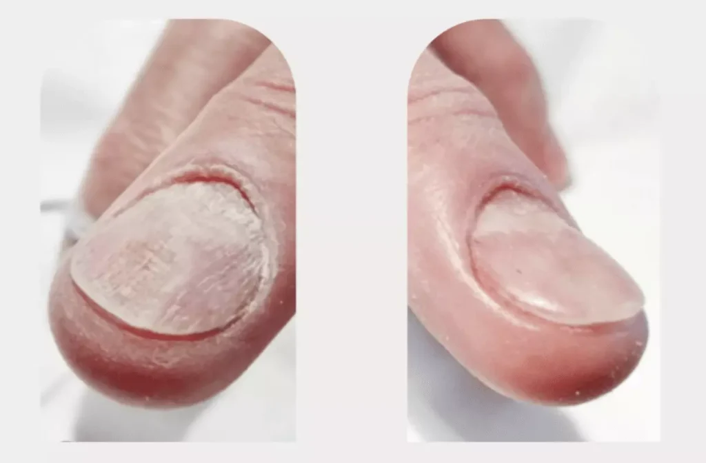 Long-Term Results of Laser Nail Fungal Treatment