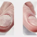 Long-Term Results of Laser Nail Fungal Treatment