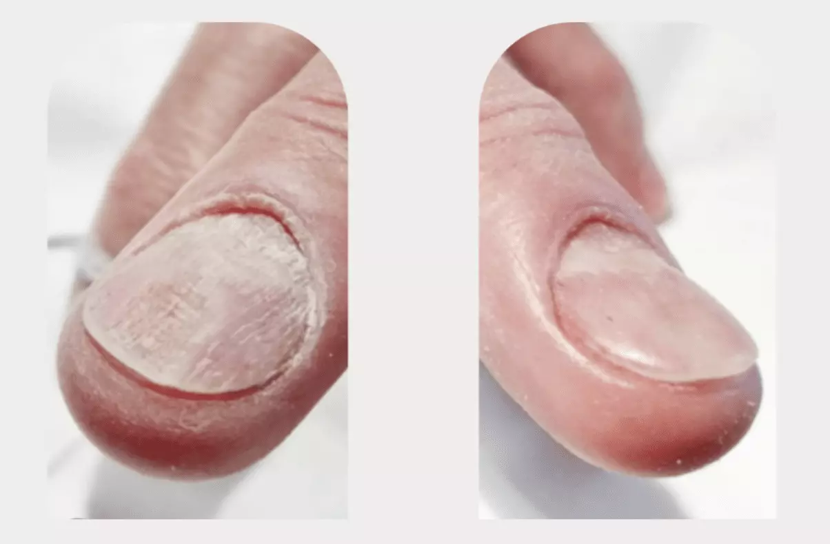 Long-Term Results of Laser Nail Fungal Treatment