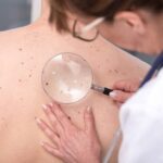 Recognizing the Signs and Symptoms of Skin Cancer