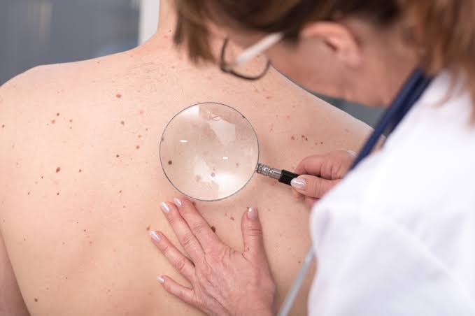 Recognizing the Signs and Symptoms of Skin Cancer
