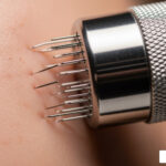 The Benefits of Microneedling for Acne Scars