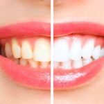 The Process of Teeth Whitening To Achieve a Brighter Smile