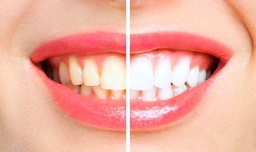 The Process of Teeth Whitening To Achieve a Brighter Smile