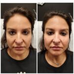 The Role of Botox in Facial Contouring