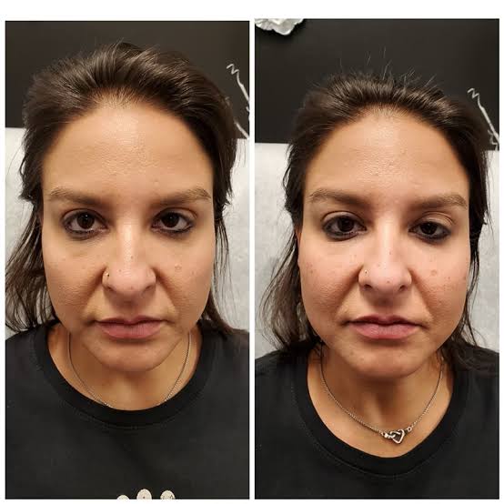 The Role of Botox in Facial Contouring
