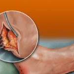The Role of Footwear in Managing Achilles Tendinitis