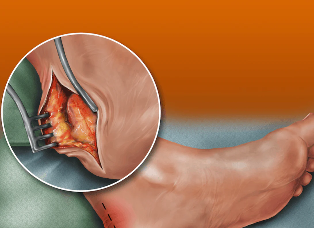 The Role of Footwear in Managing Achilles Tendinitis