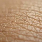 The Role of Mohs Micrographic Surgery in Preventing Skin Cancer Recurrence