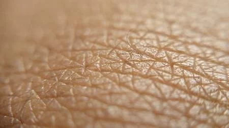 The Role of Mohs Micrographic Surgery in Preventing Skin Cancer Recurrence