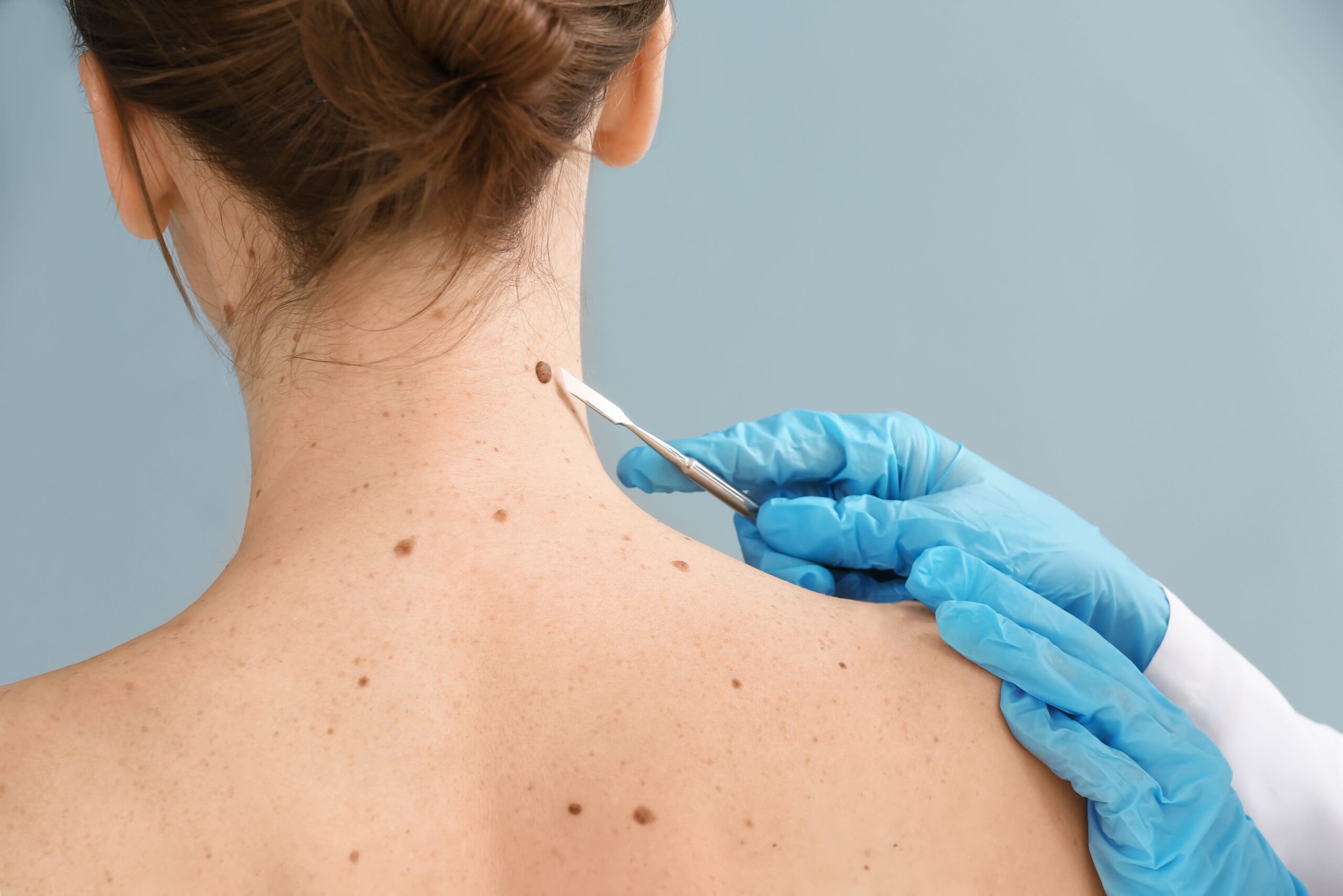 Types of Skin Cancer Services Available to Patients
