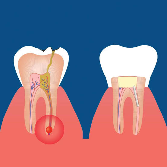 Understanding the Root Canal Procedure
