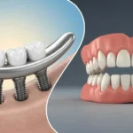 Benefits of Choosing Dental Implants Over Traditional Dentures