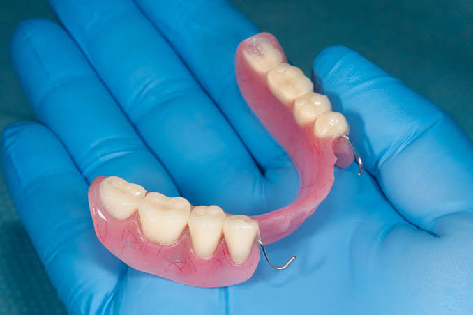 Exploring the Advantages of Partial Dentures for Missing Teeth