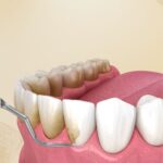 The Role of Periodontal Treatments in Preventing Tooth Loss